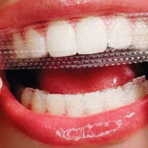 Usage guidance of Crest Whitening strips