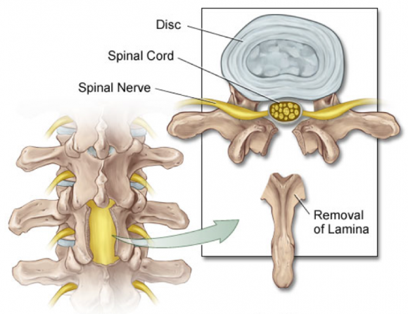 Everything You Need To Know About Laminectomy Surgery ￼