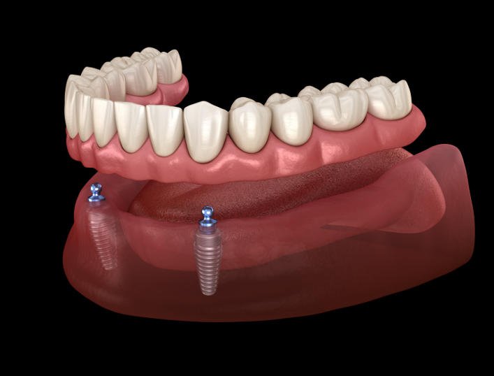 Difference between Dental Implants and Dentures